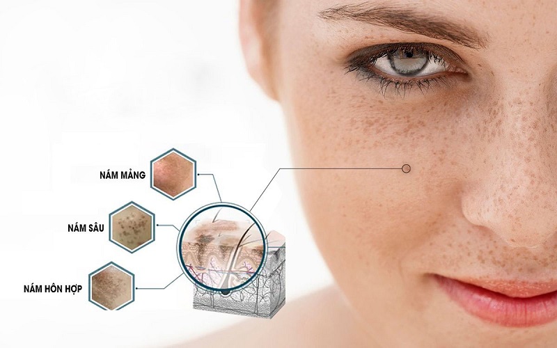 Trị nám bằng lá tía tô có hiệu quả không