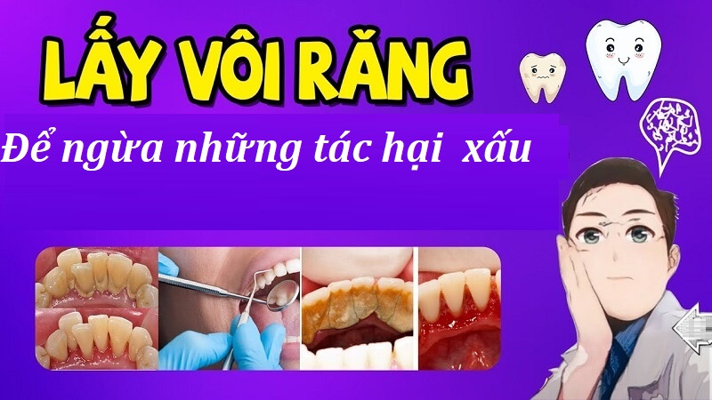 Vôi răng đem đến nhiều tác hại, vậy nên cần lấy vôi răng định kỳ