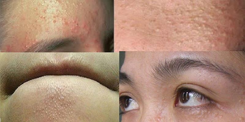 Cải thiện tình trạng mụn ẩn khi xông mặt bằng tỏi